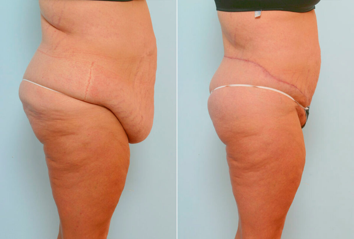 Body Lift before and after photos in Houston, TX, Patient 26968