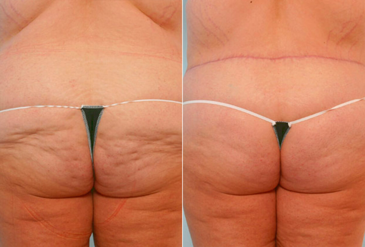 Body Lift before and after photos in Houston, TX, Patient 26968