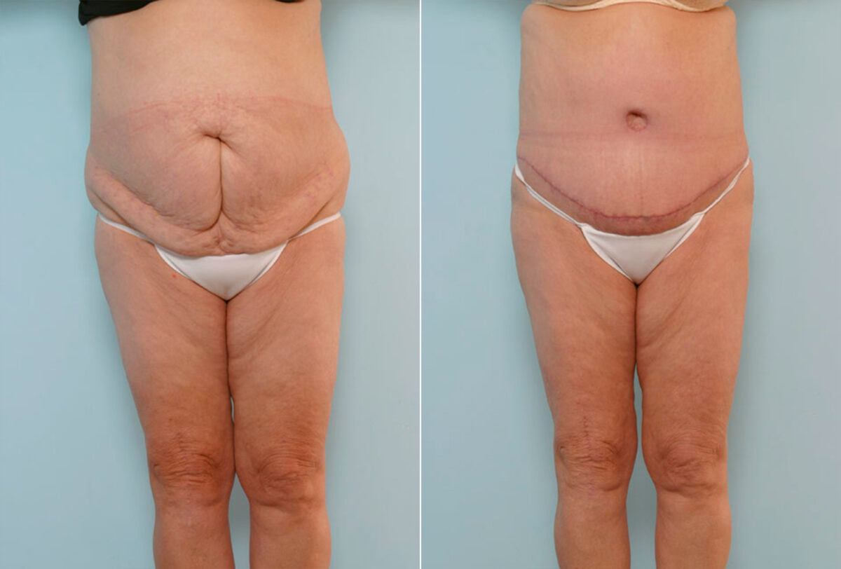 Abdominoplasty before and after photos in Houston, TX, Patient 24475