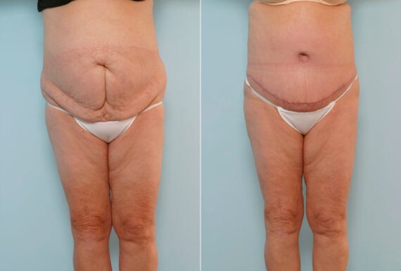 Tummy Tuck/Abdominoplasty before and after photos in Houston, TX, Patient 24475
