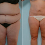 Body Lift before and after photos in Houston, TX, Patient 26977