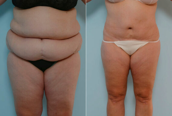 Body Lift before and after photos in Houston, TX, Patient 26977