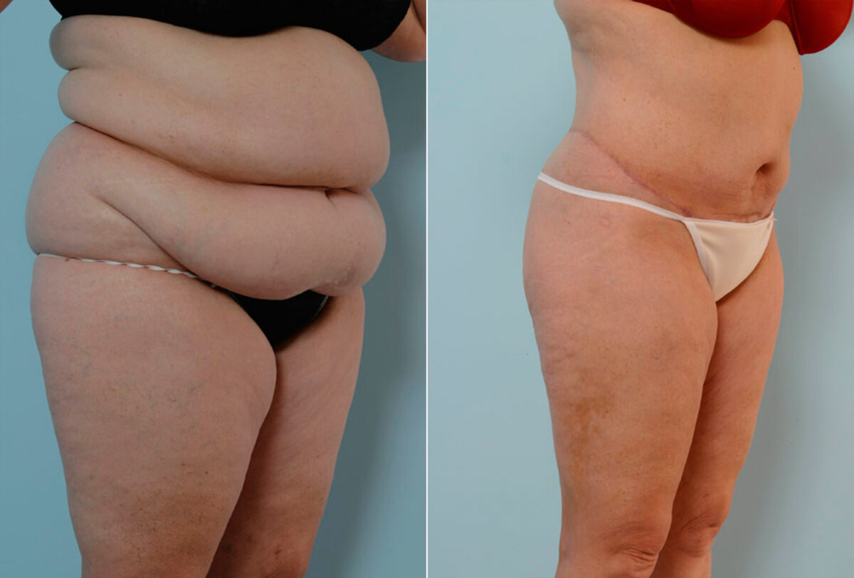 Body Lift before and after photos in Houston, TX, Patient 26977