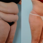 Body Lift before and after photos in Houston, TX, Patient 26977