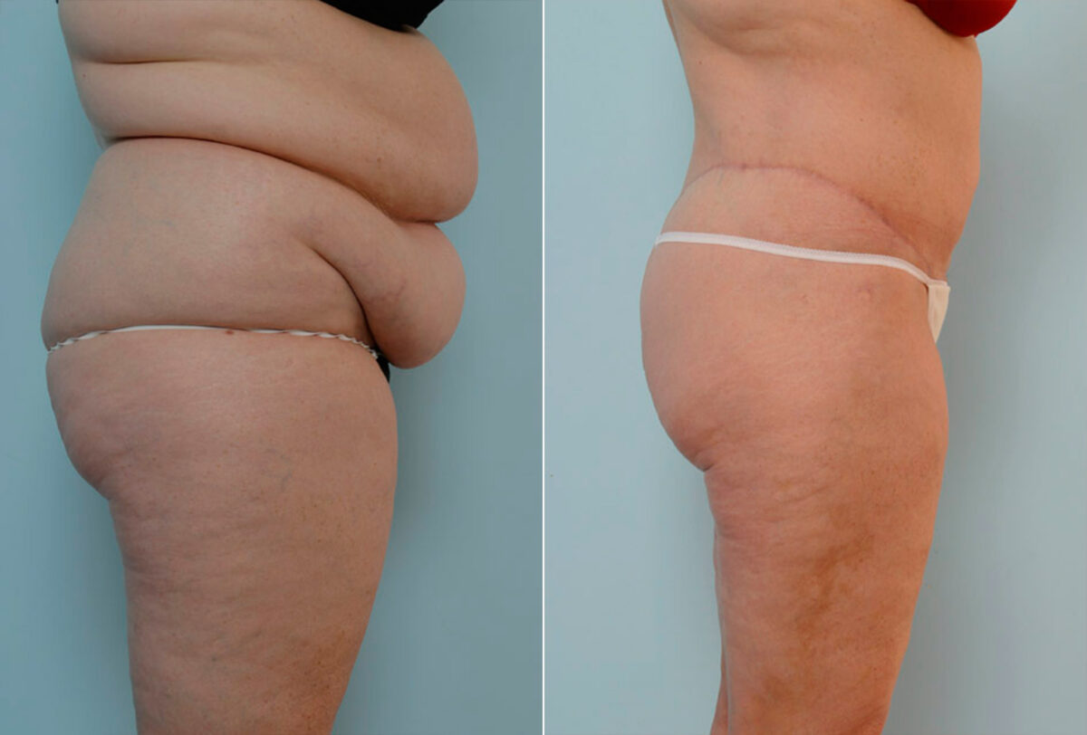 Body Lift before and after photos in Houston, TX, Patient 26977