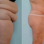 Body Lift before and after photos in Houston, TX, Patient 26977