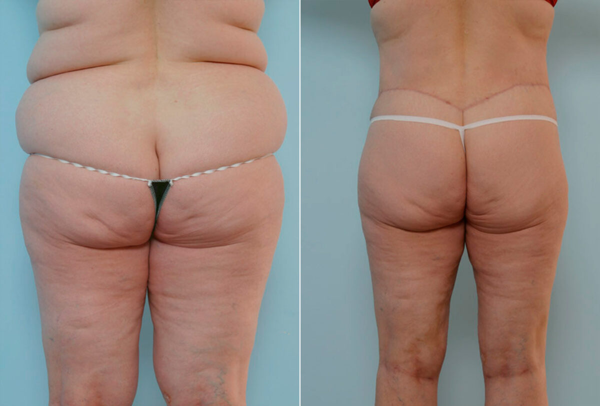 Body Lift before and after photos in Houston, TX, Patient 26977