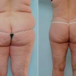 Body Lift before and after photos in Houston, TX, Patient 26977