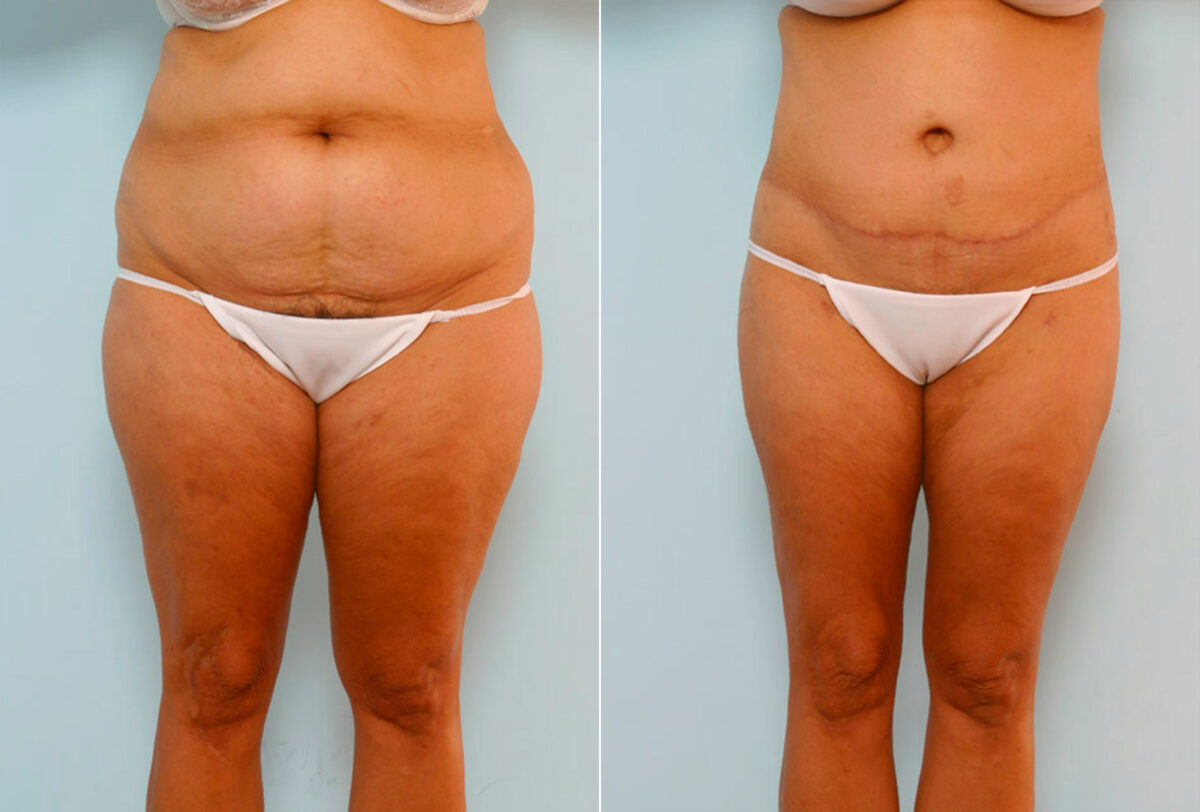 Body Lift before and after photos in Houston, TX, Patient 26986