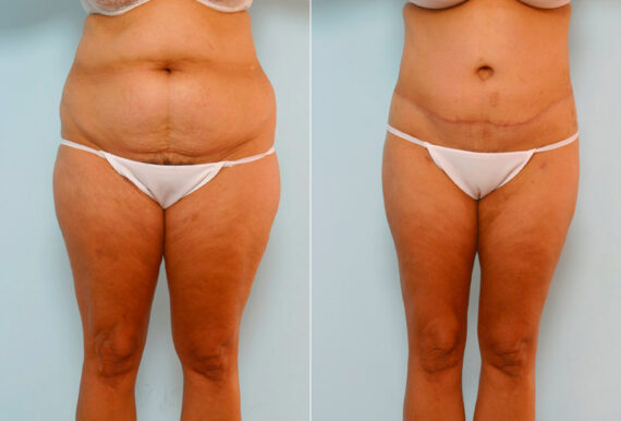 Body Lift before and after photos in Houston, TX, Patient 26986