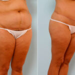 Body Lift before and after photos in Houston, TX, Patient 26986