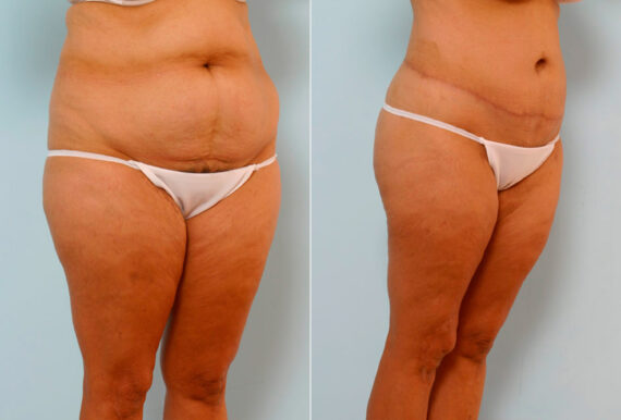 Body Lift before and after photos in Houston, TX, Patient 26986