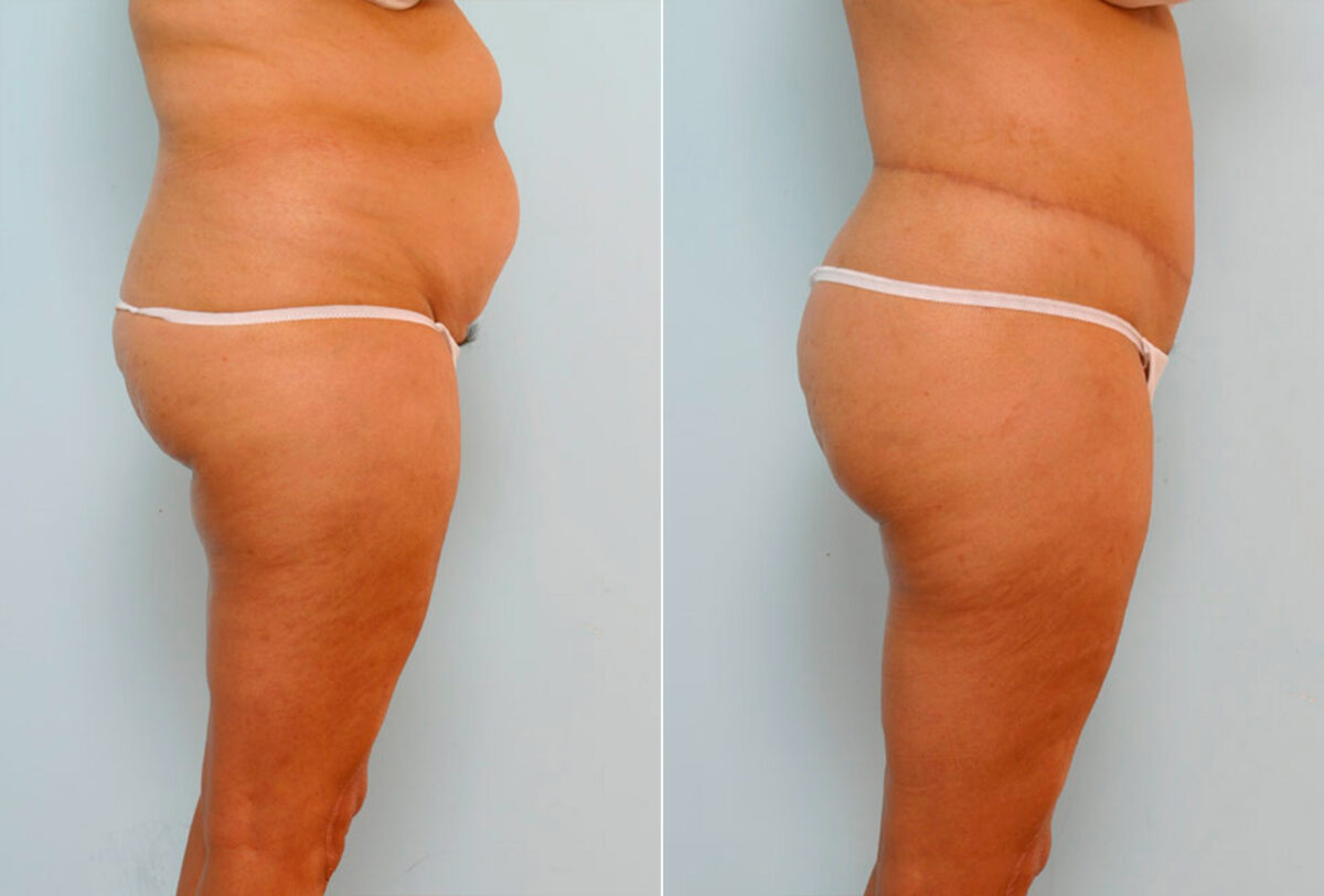 Body Lift before and after photos in Houston, TX, Patient 26986