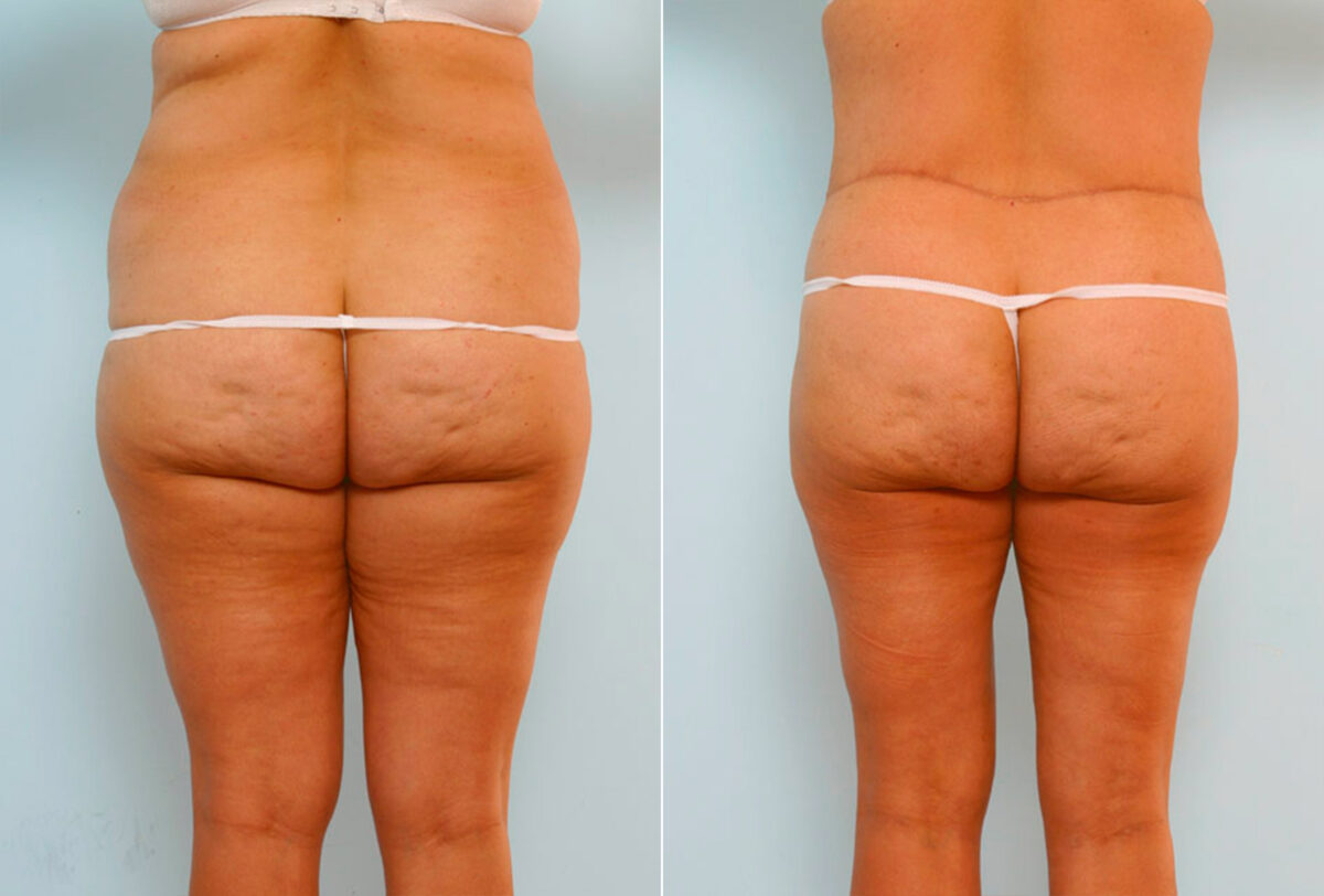 Body Lift before and after photos in Houston, TX, Patient 26986