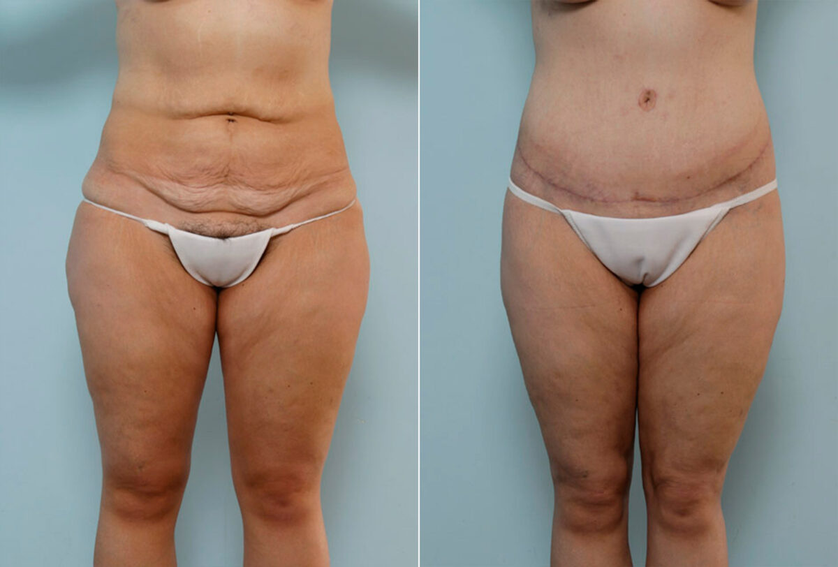 Body Lift before and after photos in Houston, TX, Patient 26995