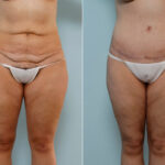 Body Lift before and after photos in Houston, TX, Patient 26995