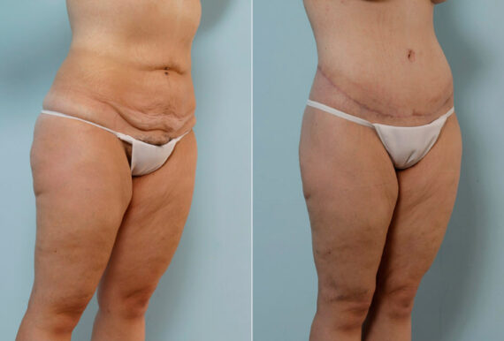 Body Lift before and after photos in Houston, TX, Patient 26995