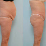 Abdominoplasty before and after photos in Houston, TX, Patient 24475