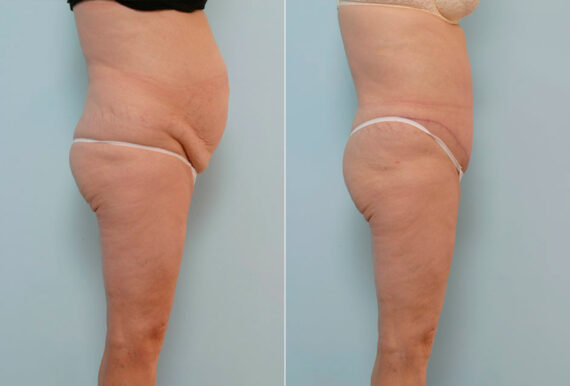 Abdominoplasty before and after photos in Houston, TX, Patient 24475