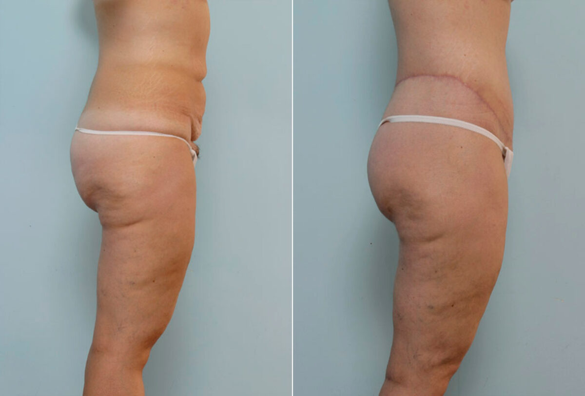 Body Lift before and after photos in Houston, TX, Patient 26995