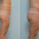 Body Lift before and after photos in Houston, TX, Patient 26995