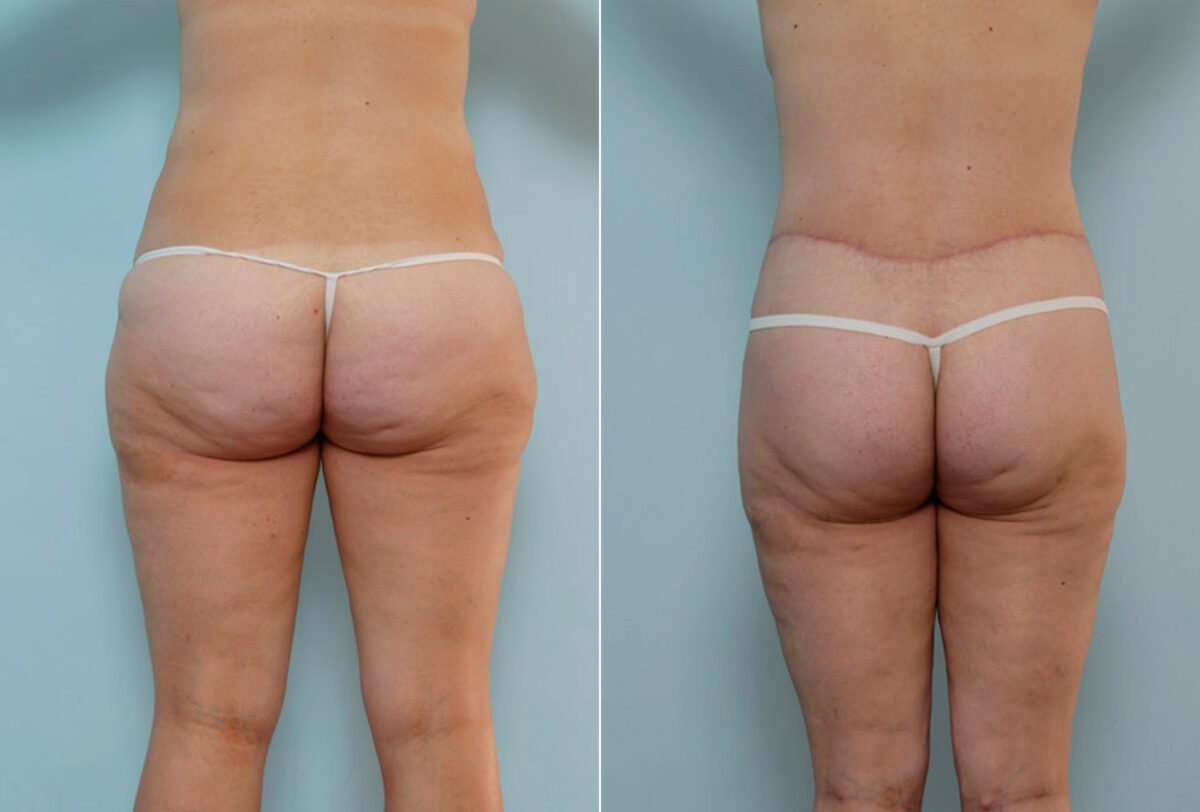 Body Lift before and after photos in Houston, TX, Patient 26995