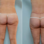 Body Lift before and after photos in Houston, TX, Patient 26995