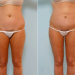 Abdominoplasty before and after photos in Houston, TX, Patient 24480