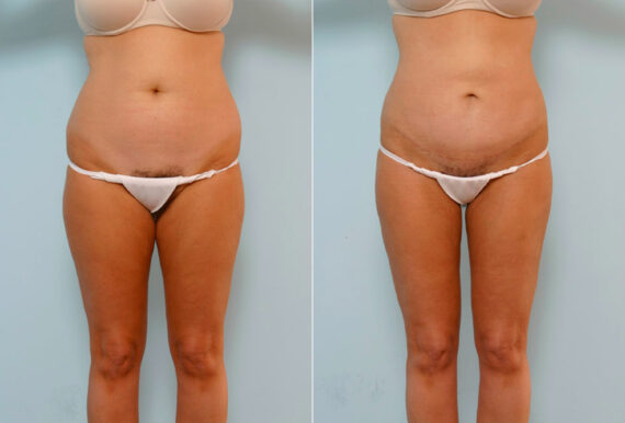 Tummy Tuck/Abdominoplasty before and after photos in Houston, TX, Patient 24480