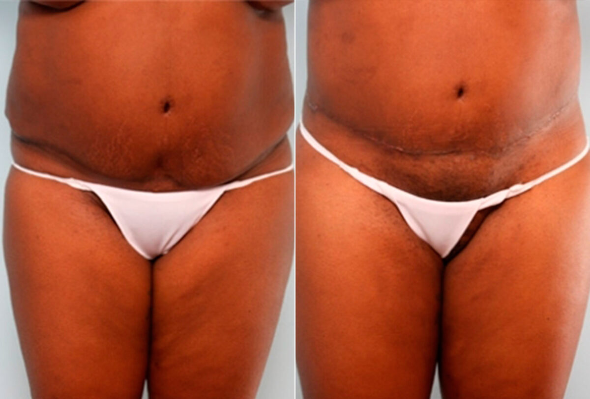 Body Lift before and after photos in Houston, TX, Patient 27031