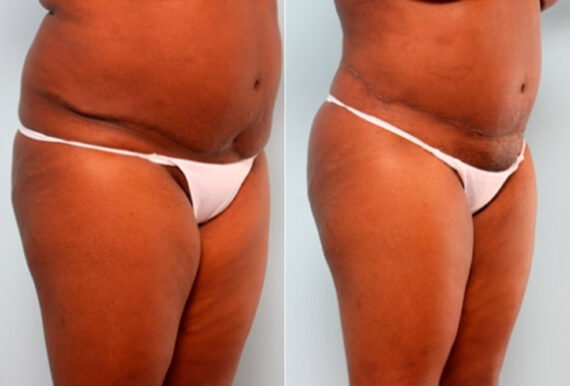 Body Lift before and after photos in Houston, TX, Patient 27031