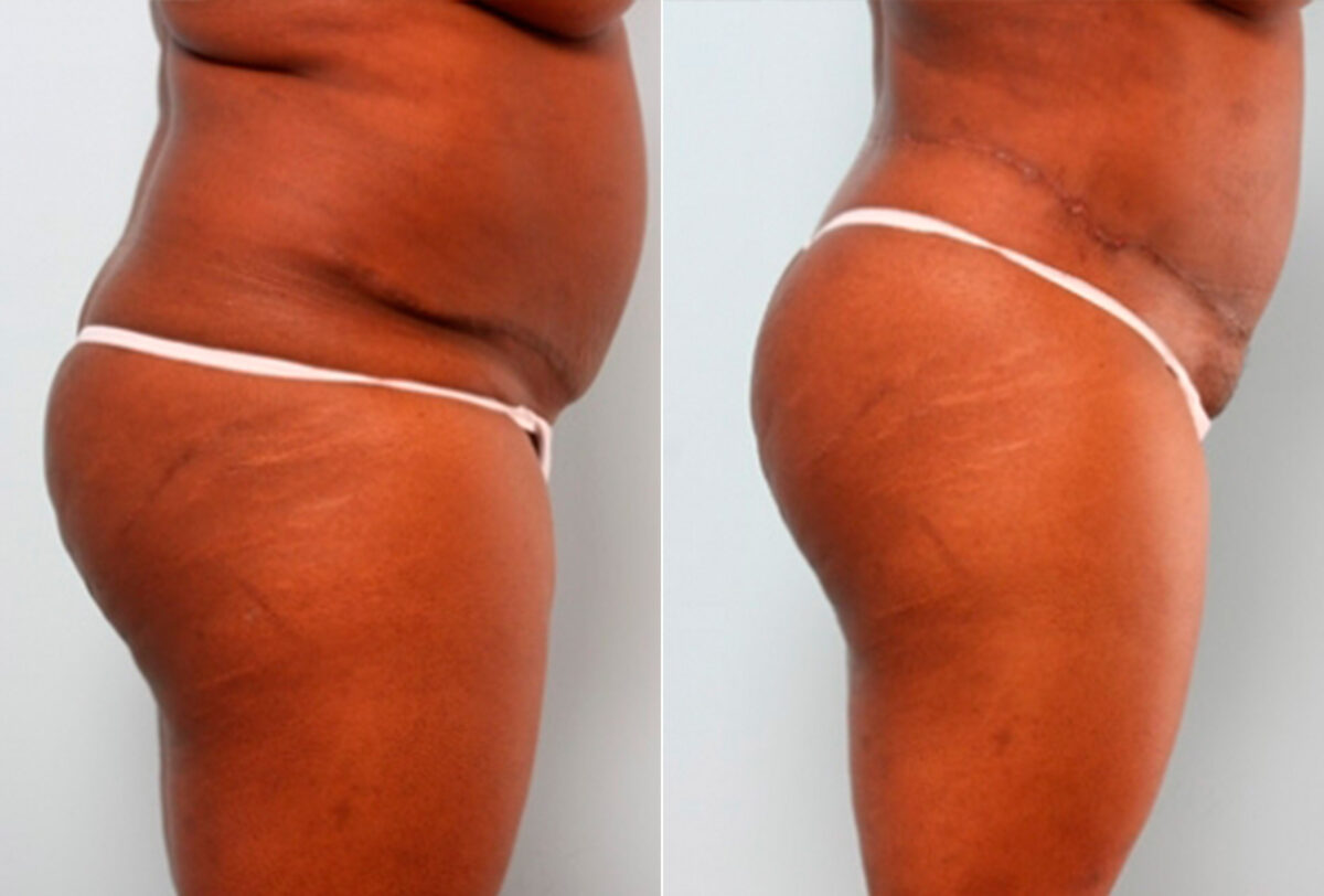 Body Lift before and after photos in Houston, TX, Patient 27031