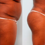 Body Lift before and after photos in Houston, TX, Patient 27031