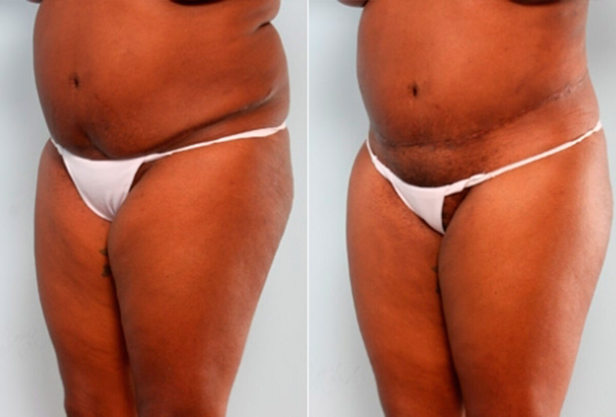 Body Lift before and after photos in Houston, TX, Patient 27031