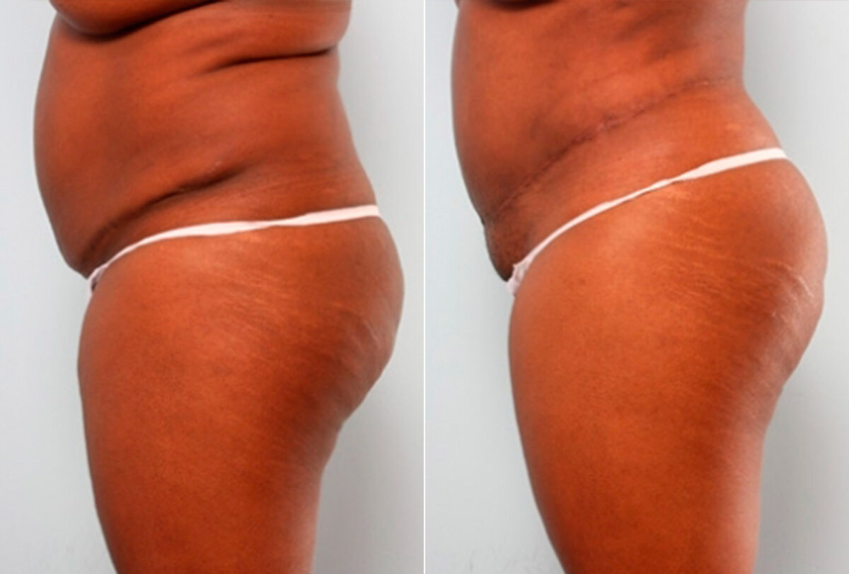 Body Lift before and after photos in Houston, TX, Patient 27031