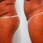 Body Lift before and after photos in Houston, TX, Patient 27031