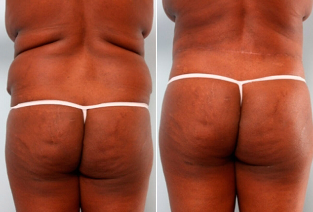 Body Lift before and after photos in Houston, TX, Patient 27031