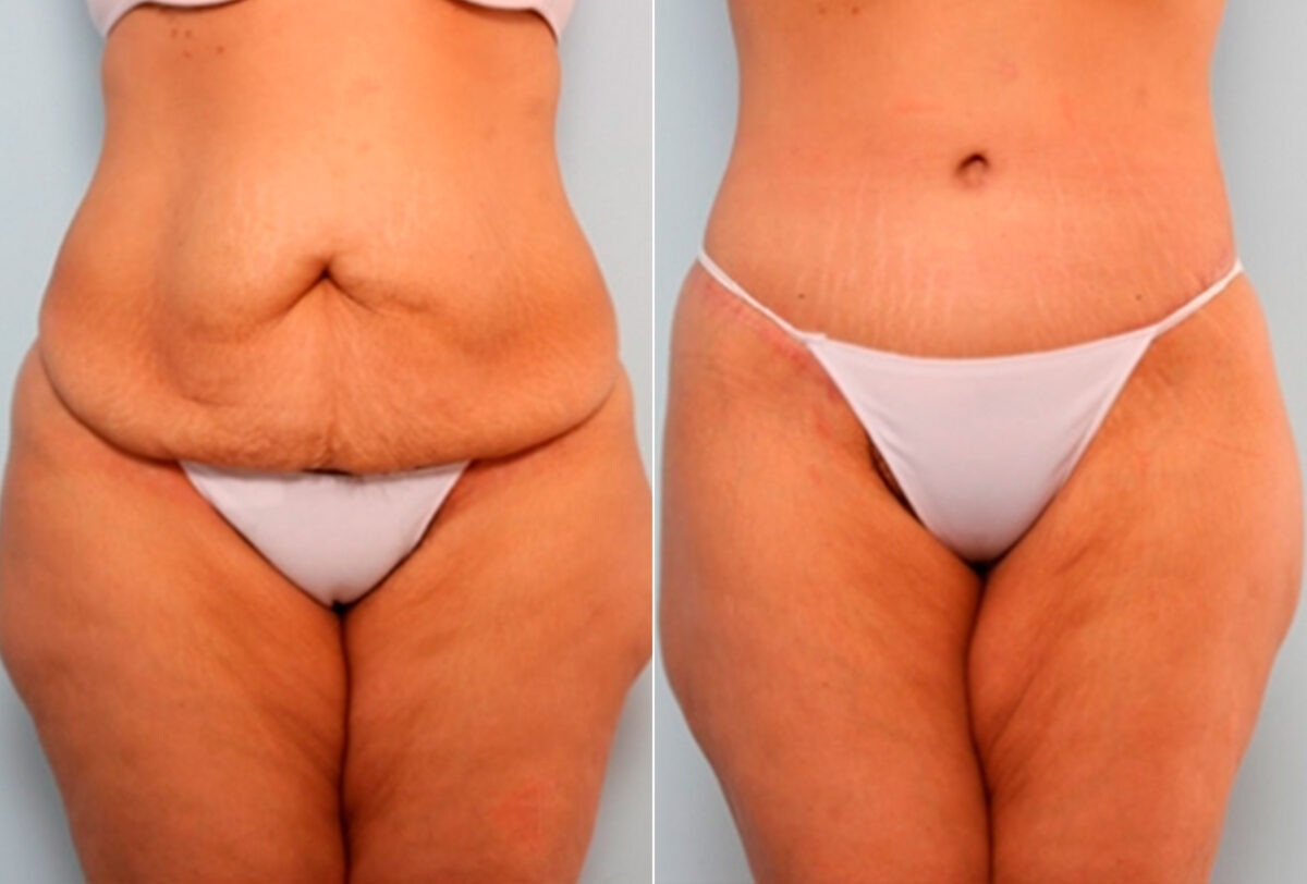 Body Lift before and after photos in Houston, TX, Patient 27044