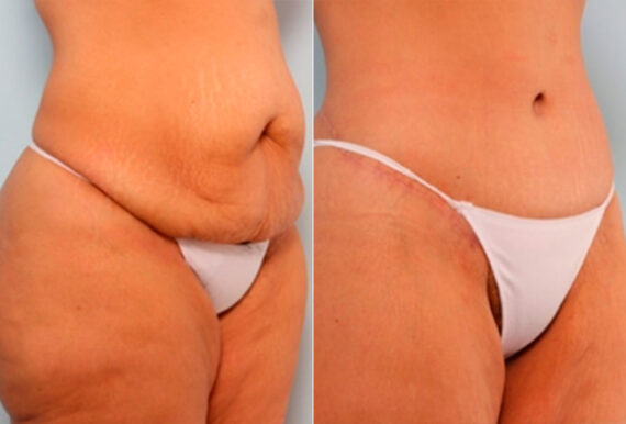 Body Lift before and after photos in Houston, TX, Patient 27044