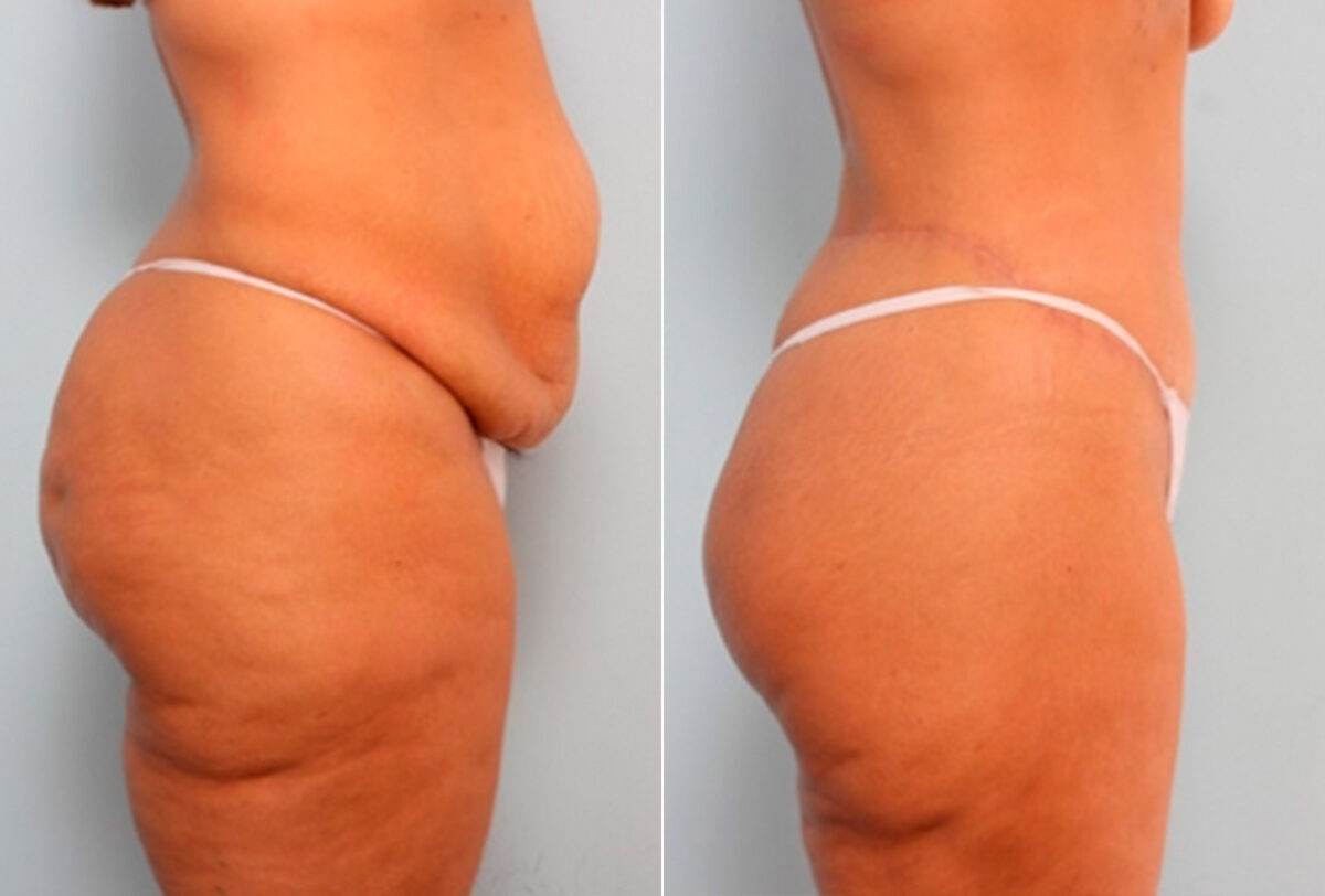 Body Lift before and after photos in Houston, TX, Patient 27044