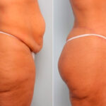 Body Lift before and after photos in Houston, TX, Patient 27044