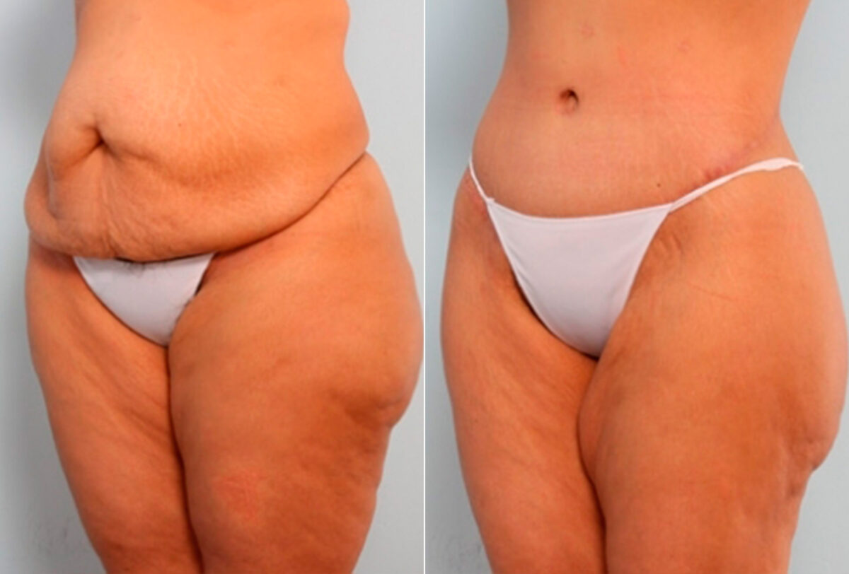 Body Lift before and after photos in Houston, TX, Patient 27044