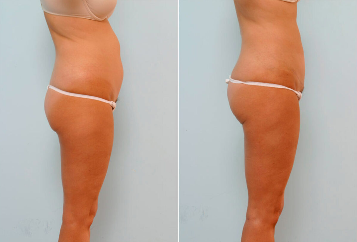 Tummy Tuck/Abdominoplasty before and after photos in Houston, TX, Patient 24480