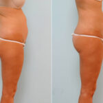 Abdominoplasty before and after photos in Houston, TX, Patient 24480