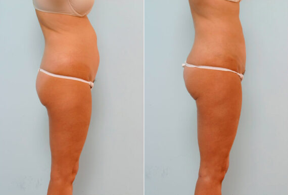 Tummy Tuck/Abdominoplasty before and after photos in Houston, TX, Patient 24480