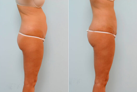 Abdominoplasty before and after photos in Houston, TX, Patient 24480