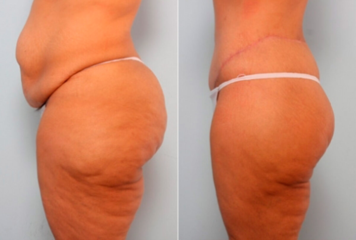 Body Lift before and after photos in Houston, TX, Patient 27044