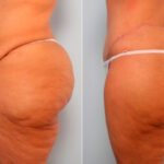 Body Lift before and after photos in Houston, TX, Patient 27044