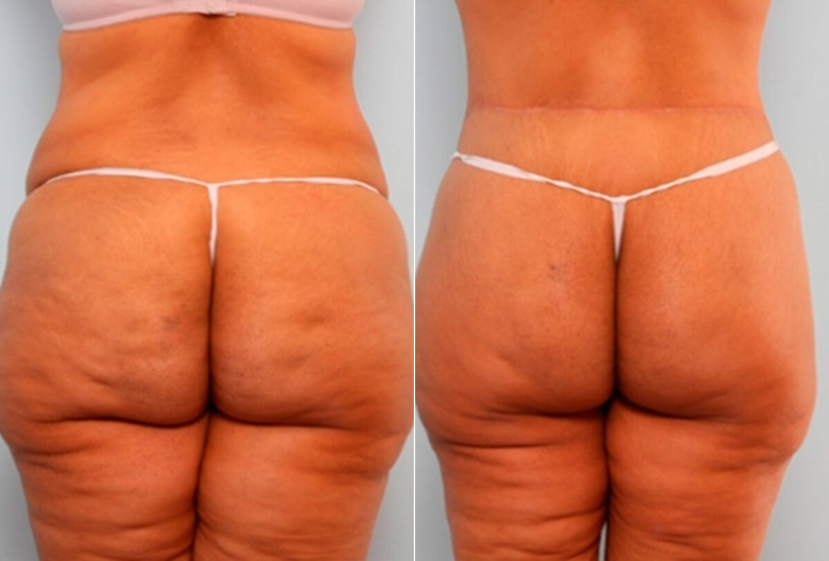 Body Lift before and after photos in Houston, TX, Patient 27044