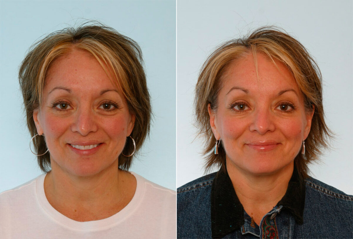 Xeomin / Botox® Cosmetic before and after photos in Houston, TX, Patient 27057